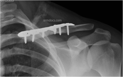 Clavicle Fracture - Plate Fixation | Arm Docs