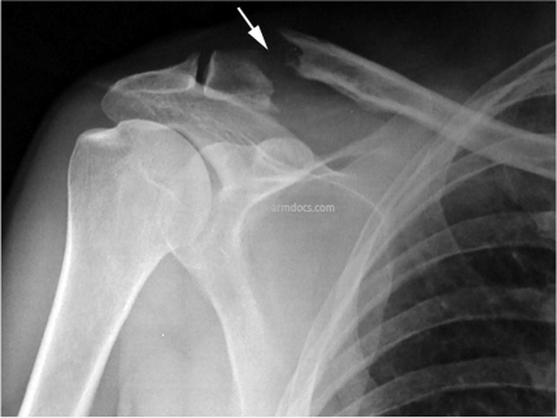 Clavicle Fracture - Suspensory Fixation | Arm Docs