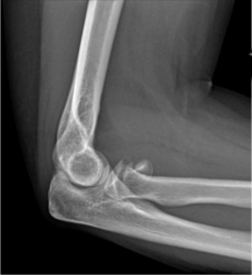 Radial Head Fracture | Arm Docs