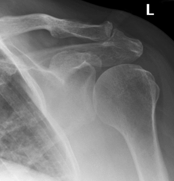 Acromioclavicular Joint Arthrosis | Arm Docs