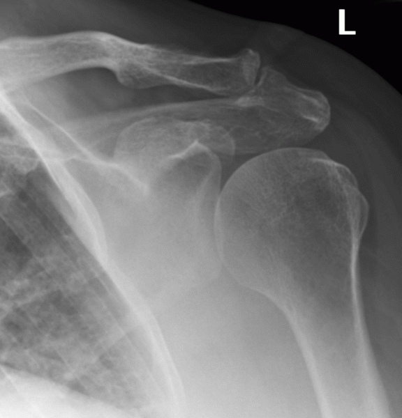Lull semafor Ved daggry Acromioclavicular Joint Arthrosis | Arm Docs