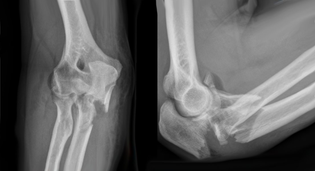 compound bone fracture